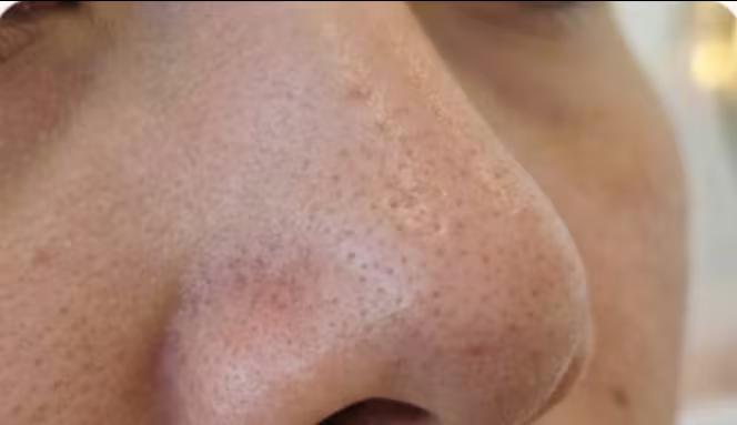 Antes - Limpeza de pele