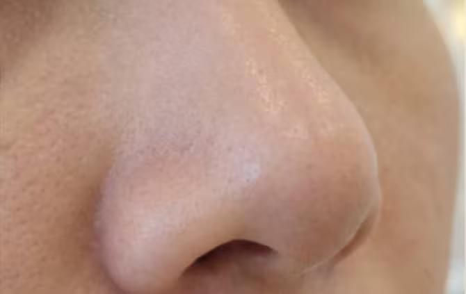 Depois - Limpeza de pele