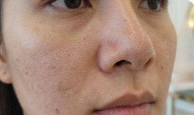 Antes - Limpeza de pele