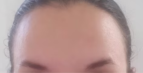 Depois - Botox
